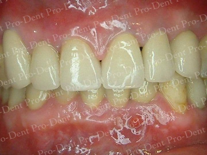 精密瓷牙-柏登牙醫案例分享-案例三2-结果-1