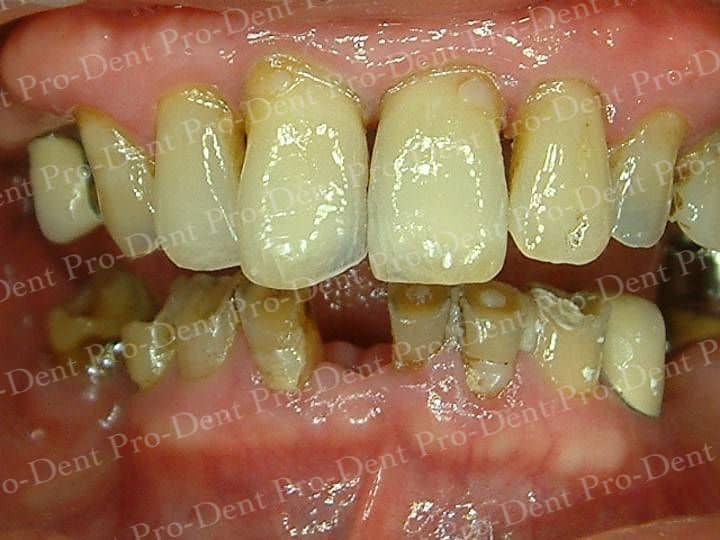 精密瓷牙-柏登牙醫案例分享-案例二1-结果-1