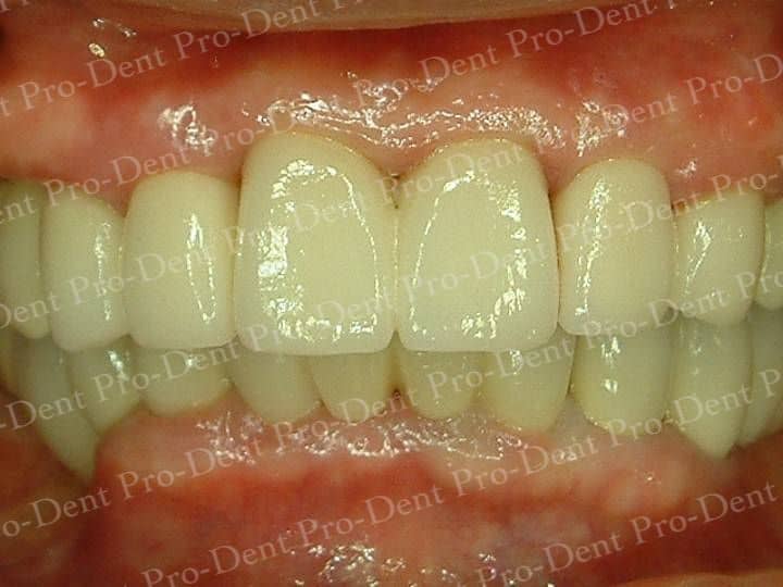 精密瓷牙-柏登牙醫案例分享-案例二2-结果-1