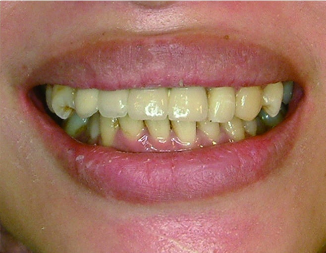 經過牙齒及牙肉的重建治療唇型恢復美觀