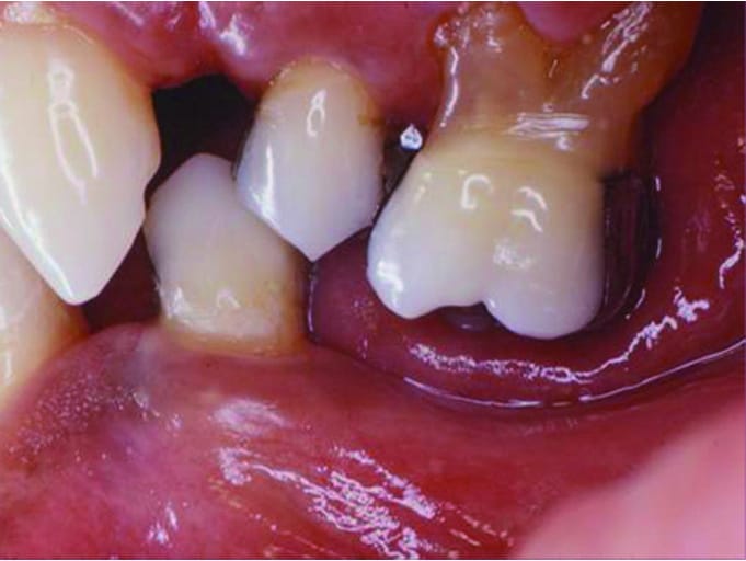 缺牙造成對咬牙增長