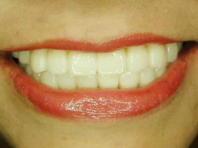 英花感謝專業有耐心的柏登牙醫，再造微笑美齒3