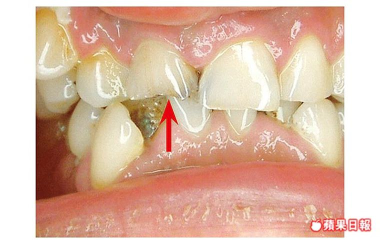 顳顎關節症候群恐致牙齒碎裂-柏豋牙醫-牙醫衛教2